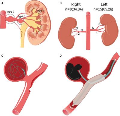 Eighteen cases of renal aneurysms: Clinical retrospective analysis and experience of endovascular interventional treatment